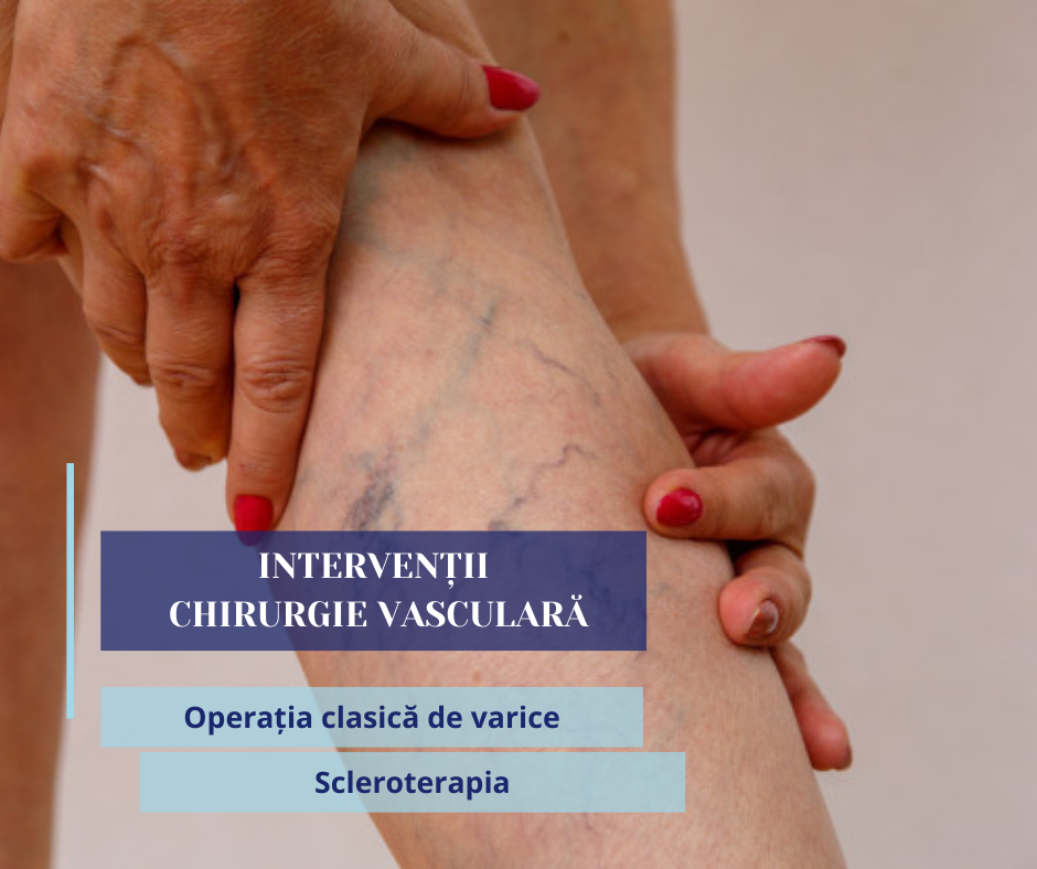chirurgie-vasculara-1